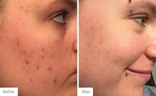 8 - Before and After Real Results photo of a woman's use of Neora's Acne Complexion Treatment Pads