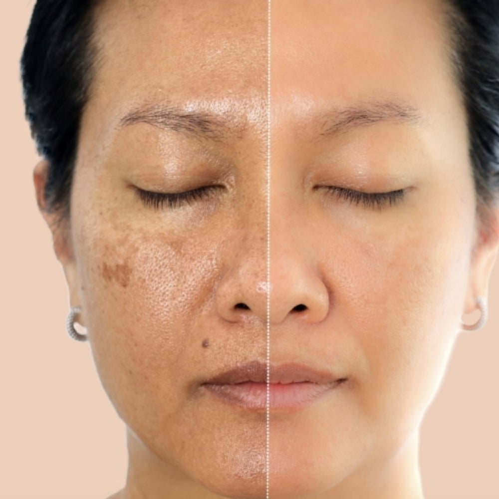 A before and after of a woman’s face from treating sun spots.