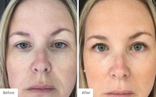 4 - Before and After Real Results photo of a woman's face.