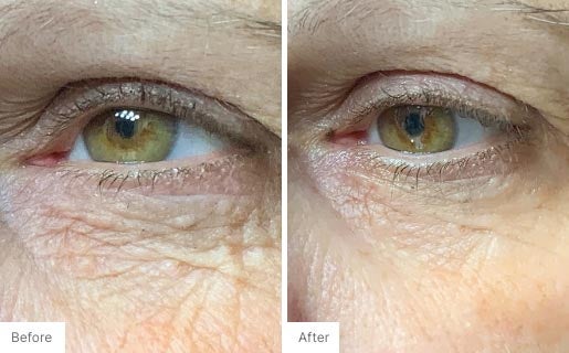 1 - Before and After Real Results photo of a woman's eye area.