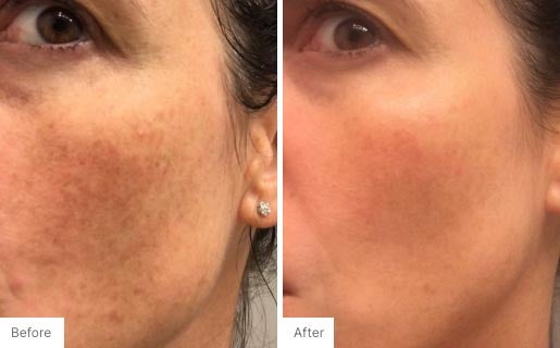 7 - Before and After Real Results photo of a woman's face.