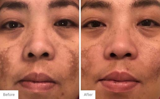 9 - Before and After Real Results photo of a woman's face.