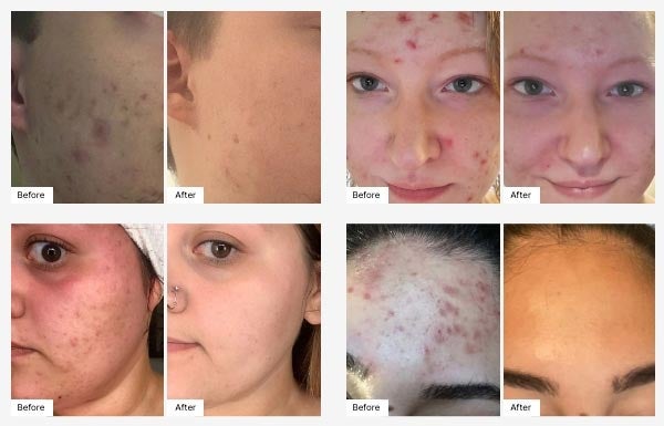 Before and After Real Result images of people using the Clear Complexion Combo.